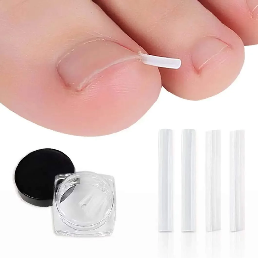 Ingrown Toe Nail Corrector